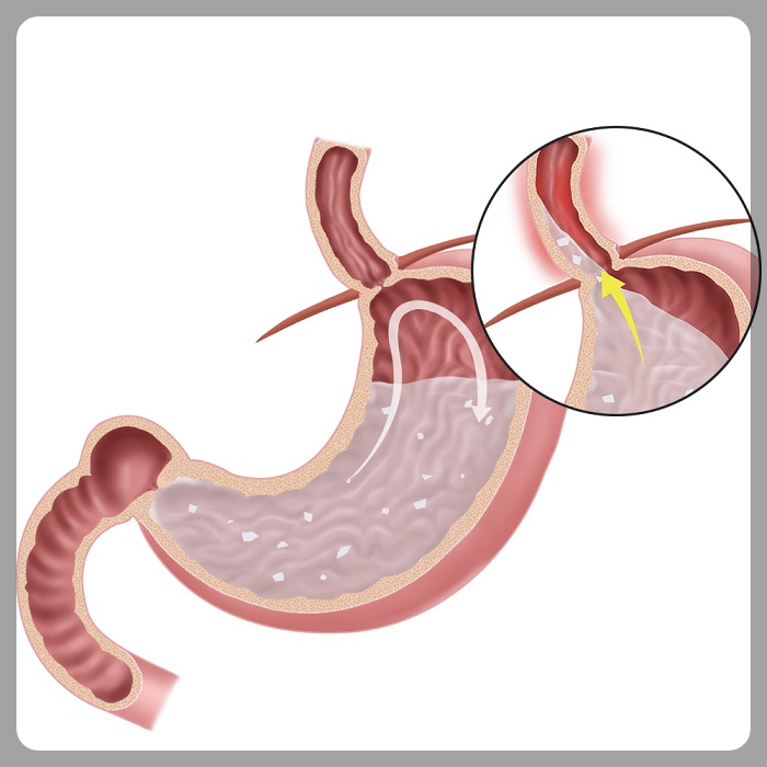 symptoms of reflux esophagitis