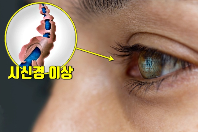 다발성경화증 증상, 의사 오진율, 의사 오진 대응 방안, 웰빙 건강 팁줌 매일꿀정보