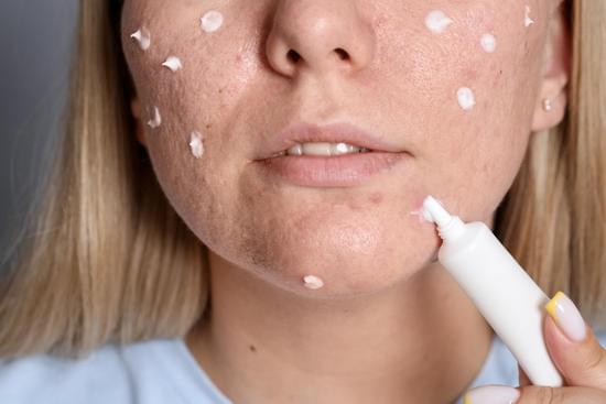 반복되는 여드름 치료 ❘ 재발을 줄이는 근본적인 관리