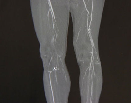 종아리 근육 통증 원인