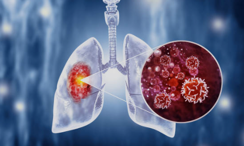 폐암