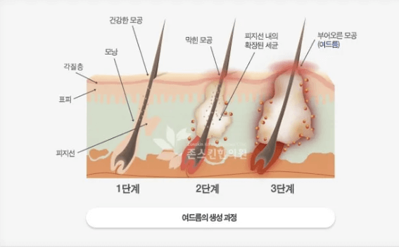 사춘기 자녀 피부 고민 해결책 - 여드름 관리 총정리