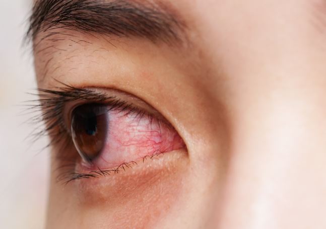 안구건조증으로 충열된 눈 사진