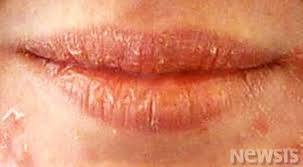 겨울에 유난히 입술이 잘 트는 이유 – 건조, 수분, 피부 과학