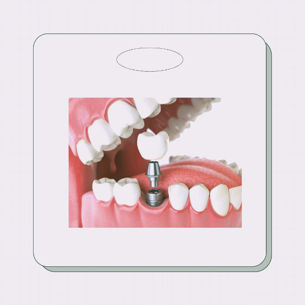 경기도 임플란트 지원금