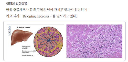 B형 간염 정의 특징 치료 예방