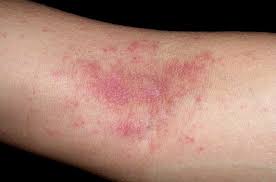 지루성 피부염 완치하려면