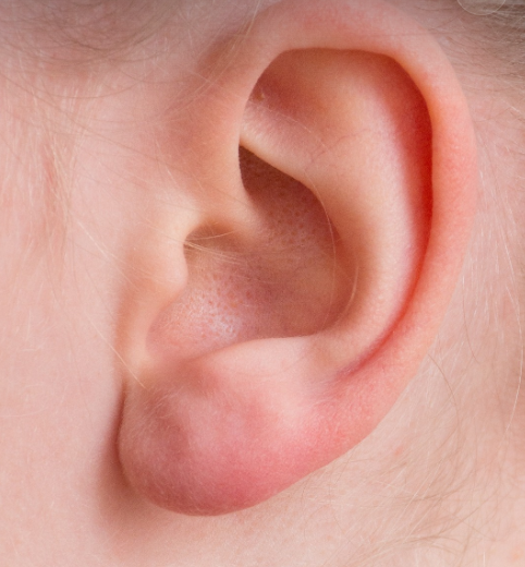 중이염 관련 이미지