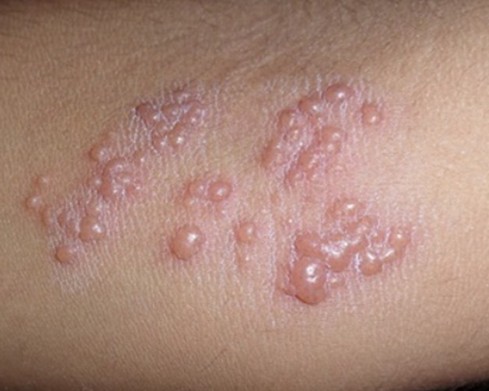 대상포진 빨리 낫는 법