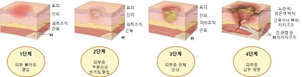 욕창 단계별 손상 정도