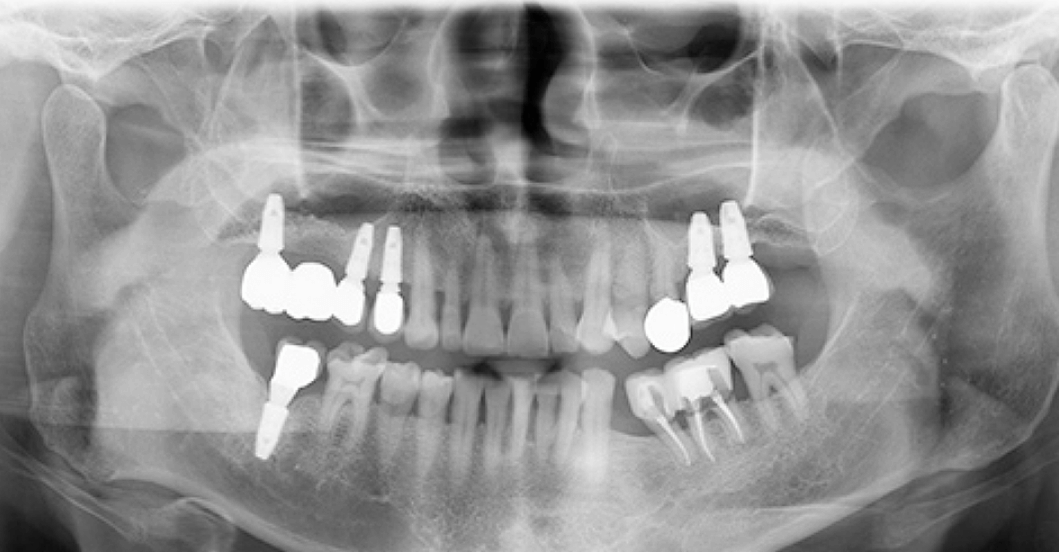부산-해운대구-임플란트-잘하는곳-추천-임플란트가격-임플란트후기