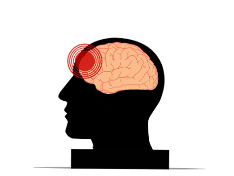 뇌가 보이는 옆모습 이미지. 뇌의 앞부분에 두통을 의미하는 빨간 동그라미가 있다.