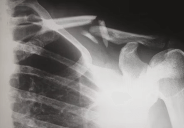 콘드로이친 효능