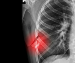 갈비뼈금간-사진5