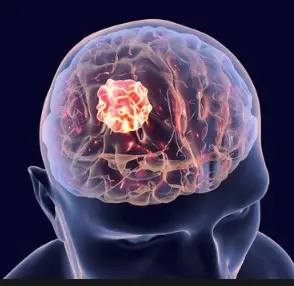 뇌암 초기증상