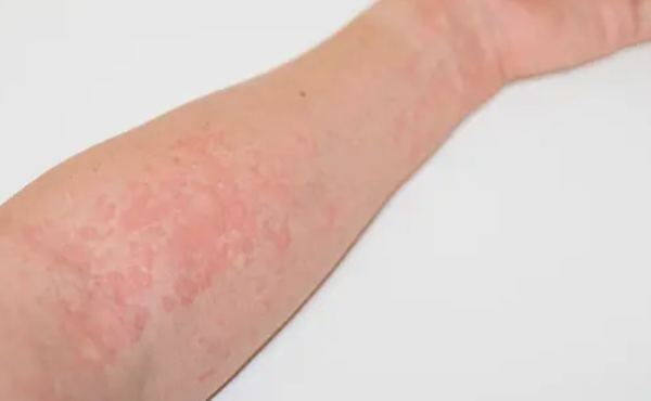 마이코플라즈마 폐렴