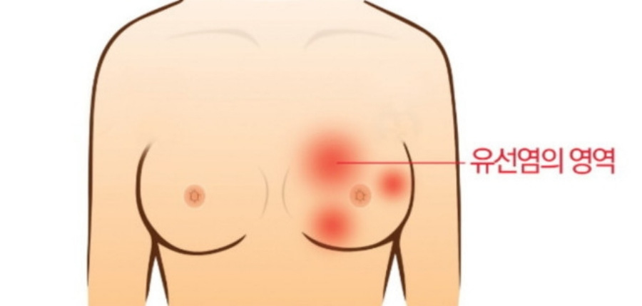 여성의 가슴 부위에서 젖꼭지 근처에서 발생하는 유선염의 발생 부위와 형태를 그림으로 그린 그림 사진