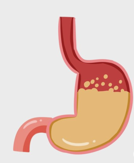 위산 역류 증상