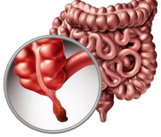 맹장염 의심 증상과 조기 대처