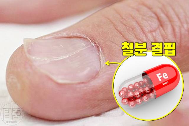 철분 부족 증상 손톱 피부
