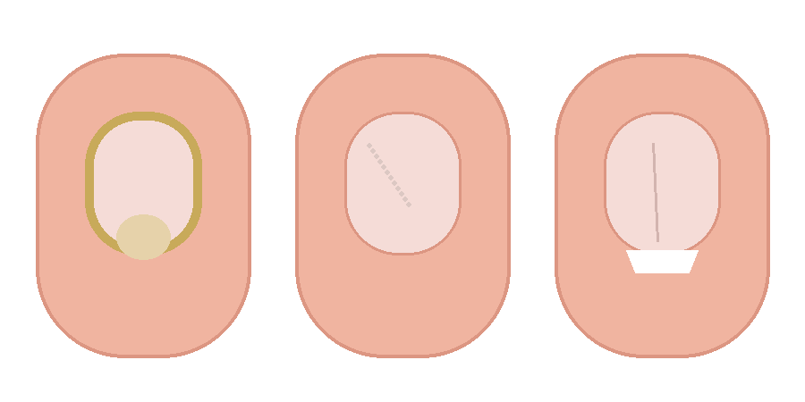 손톱무좀 vs 손톱건선 vs 단순 손상(네일·건조) 감별법: 헷갈리는 손톱 변형을 구분하는 기준