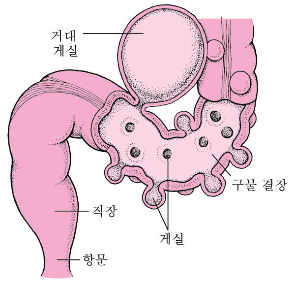 대장 게실염