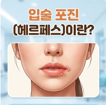 입술 포진 빨리낫는법 