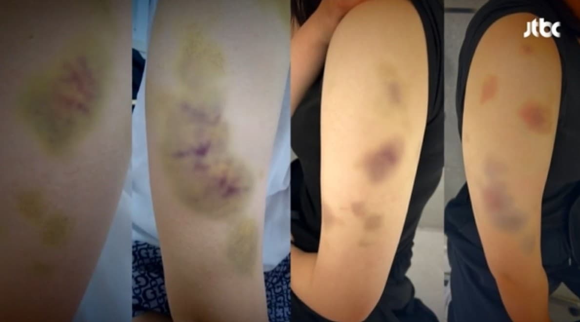 술취한 태권도 코치, 여고생 숙소 습격해 선수 폭행 : 아동학대 혐의 뿐만 아니라 특수 상해로도 처벌 가능할까?