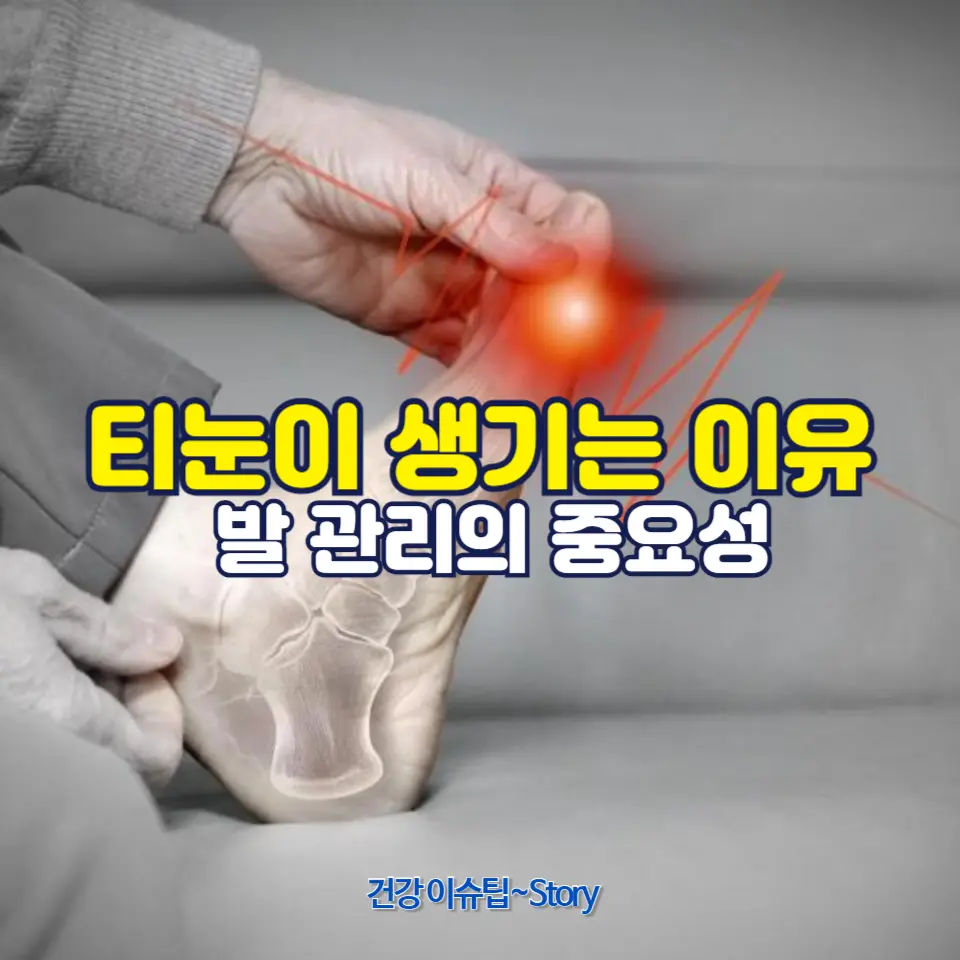 티눈이 생기는 주요 원인