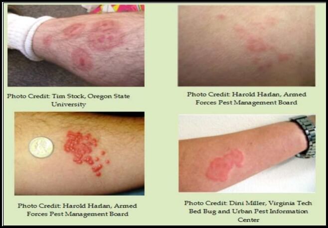 빈대 물림 증상