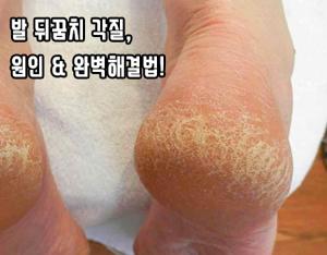 발바닥갈라짐