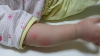 모기 물려 가려울 때 땀띠에 안티푸라민 연고 효능 부작용 사용후기_19