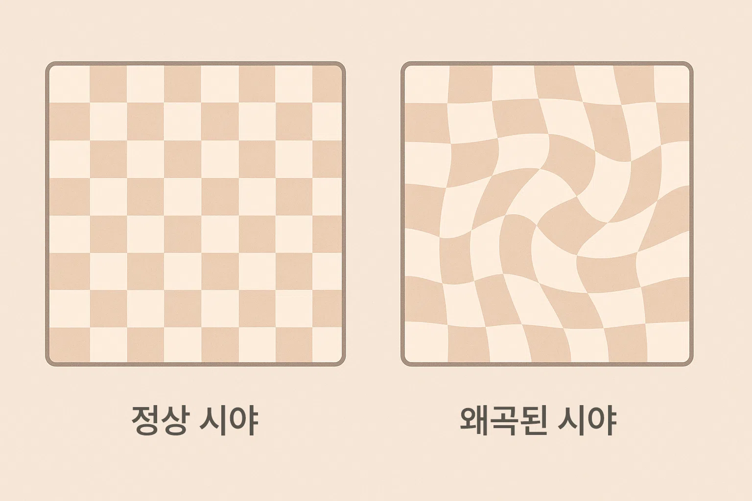 비율, 욕실 타일이나 바둑판, 모니터 테두리의 직선이 물결처럼 구불구불하게 변형된 시야, 정상 시야와 변시증 시야 비교