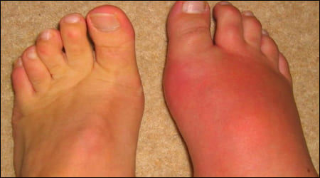 통풍이 심해진 발