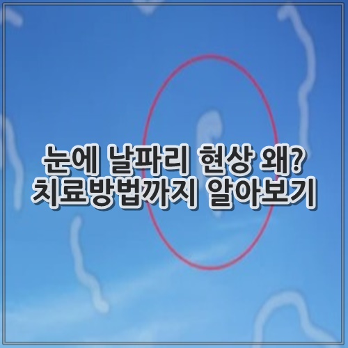 눈에 날파리 현상 왜? 치료방법까지 알아보기