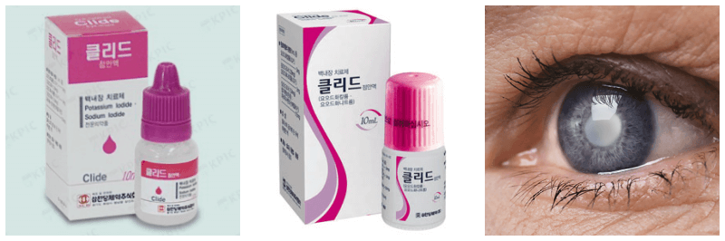 클리드점안액, 백내장 사진