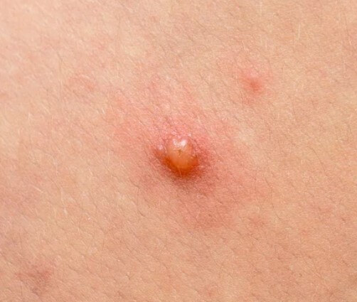 대상포진 초기증상 대상포진 조기치료 대상포진 초기증상 및 조기치료