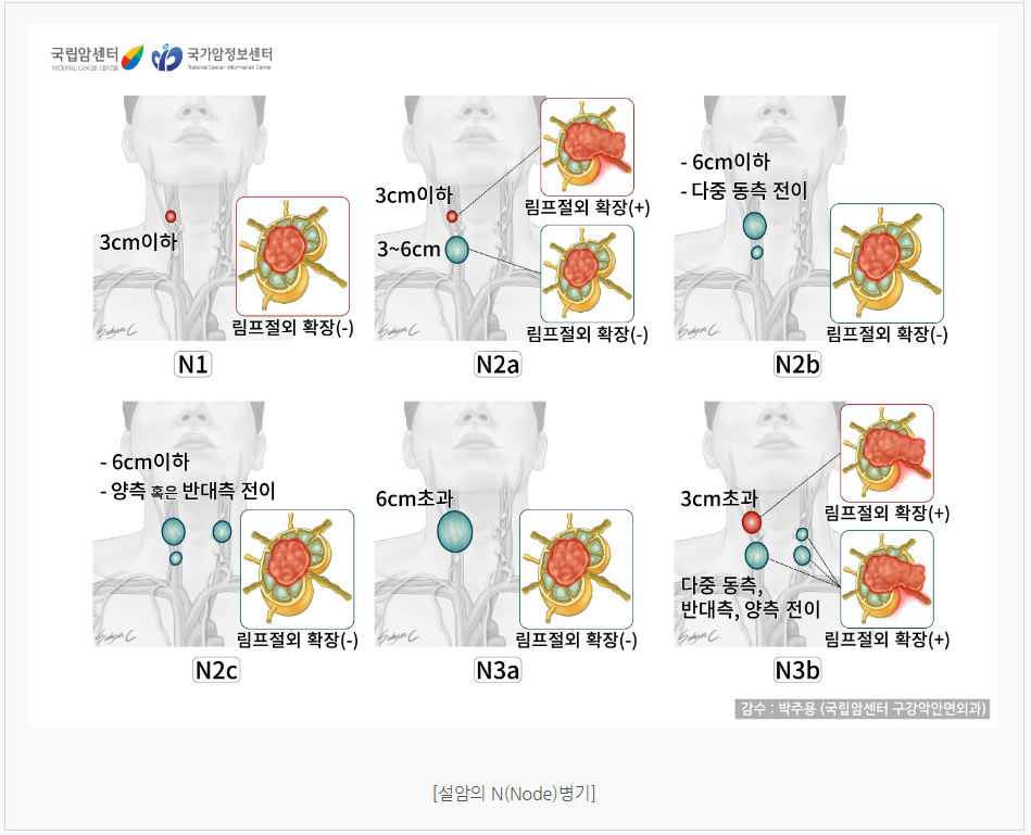 설암 침샘암 편도암 초기증상