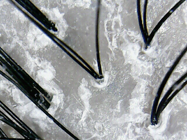 지성 두피 건성 두피 민감성 두피 탈모증상