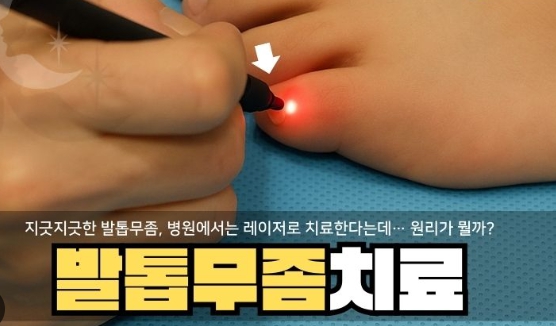 발톱무좀 가이드