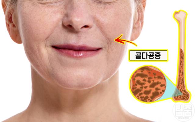 얼굴주름 골다공증 팔자주름 귓볼주름 심장마비