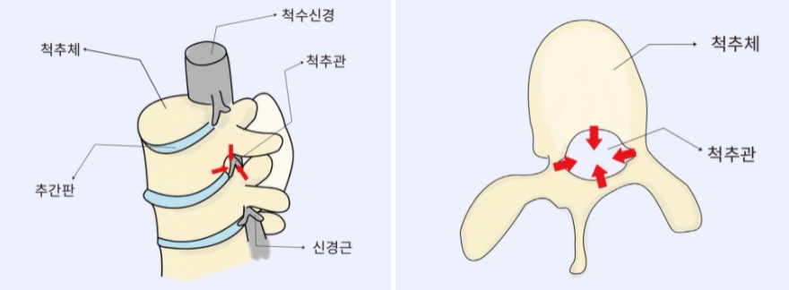 척추관협착증 원인