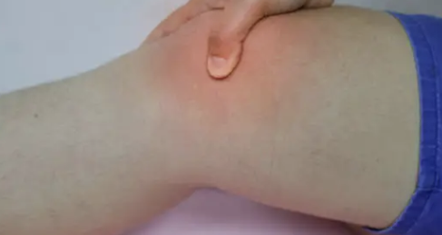 하지정맥 증상 13