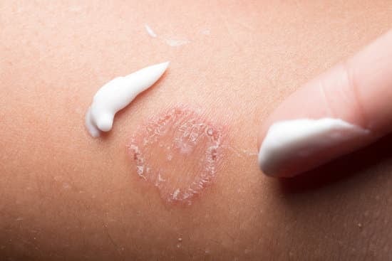 백선 (Ringworm) – 피부 곰팡이 감염