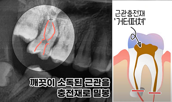 재신경치료과정, 재충전_출처:유튜브라이브치과병원