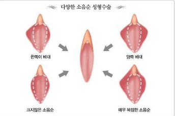 ㅅㅇㅅ수술 전후사진