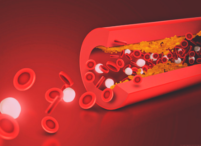 고지혈증 예방과 관리법