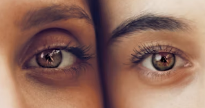 눈밑 지방재배치 수술비용 회복기간 부작용 수술방법