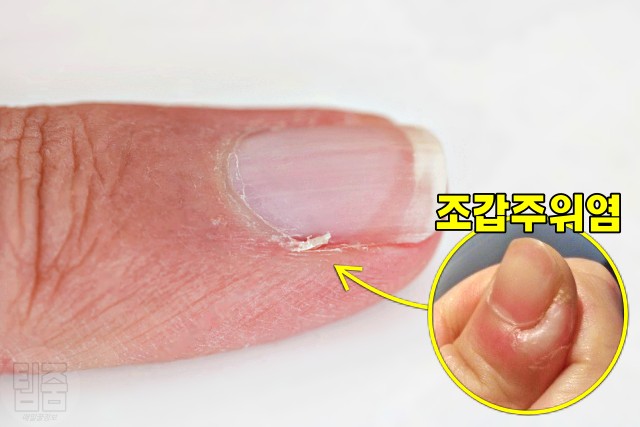 손톱 주변 살, 손톱 까시래기, 손톱 거스러미,건강 팁줌 매일꿀정보