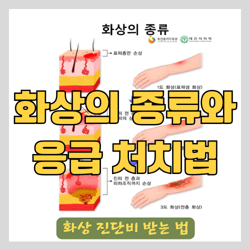 의료진이 알려주는 화상 종류(표재성,심재성)와 응급처치법(후시딘, 마데카솔, 화상연고, 메디폼, 바세린, 비판텐..) 그리고 화상 진단비 받는 법 썸네일